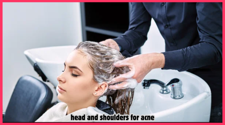 head and shoulders for acne